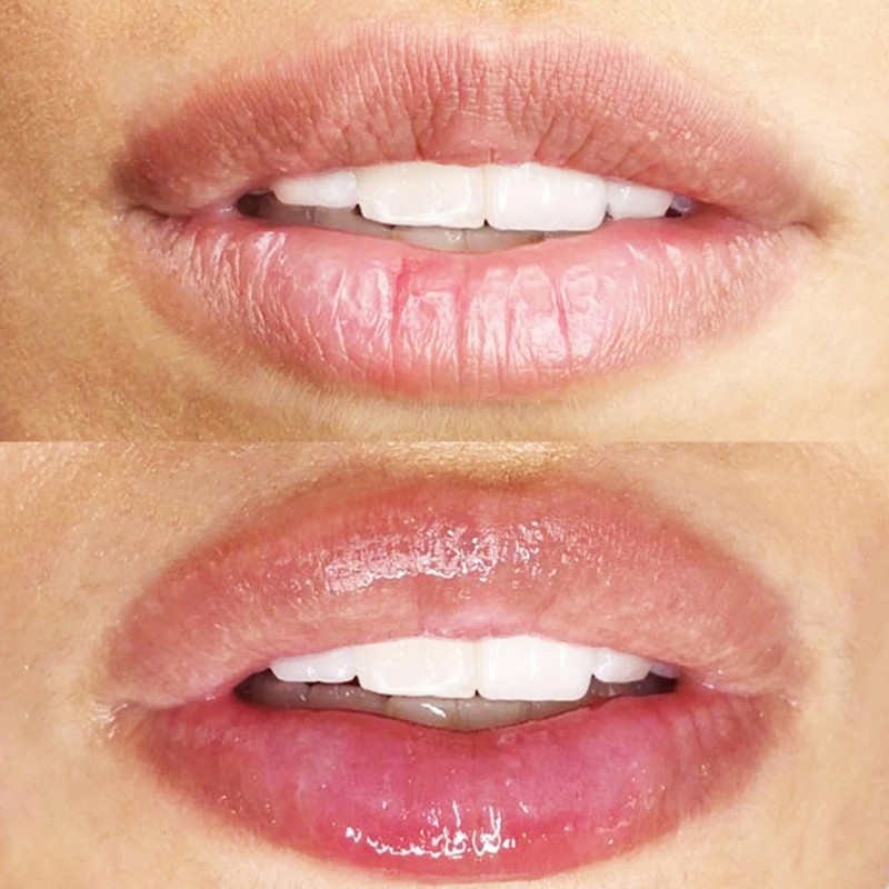 Corso Online Hydra Lips e Biorivitalizzazione Labbra | Pharma Italia