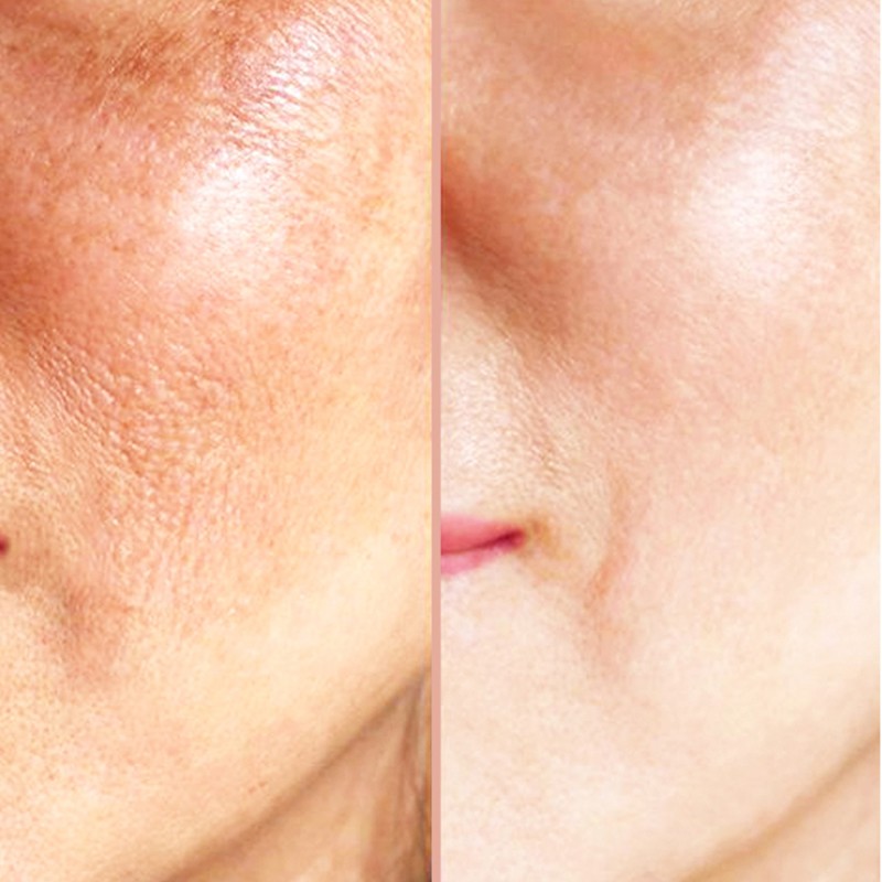 Nanoneedling Viso e Collo: Rigenerazione e Glow 97% | Pharmaitalia