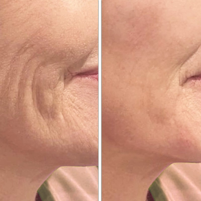 Radiofrequenza Viso e Collo: Effetto Lifting | Pharma Italia