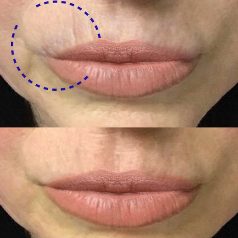 Focus Codice a Barre: Addio Rughe Labiali con Microneedling | Pharmaitalia