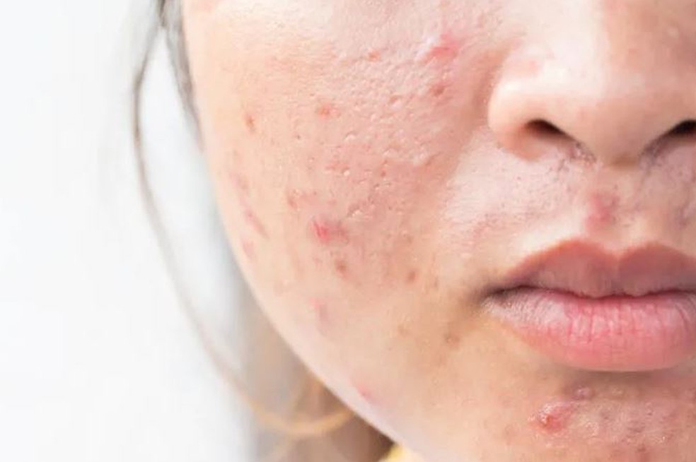 Acne 