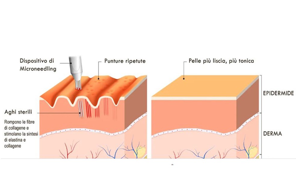 Addio ai Segni del Passato: Il Potere del Microneedling contro le Cicatrici da Acne