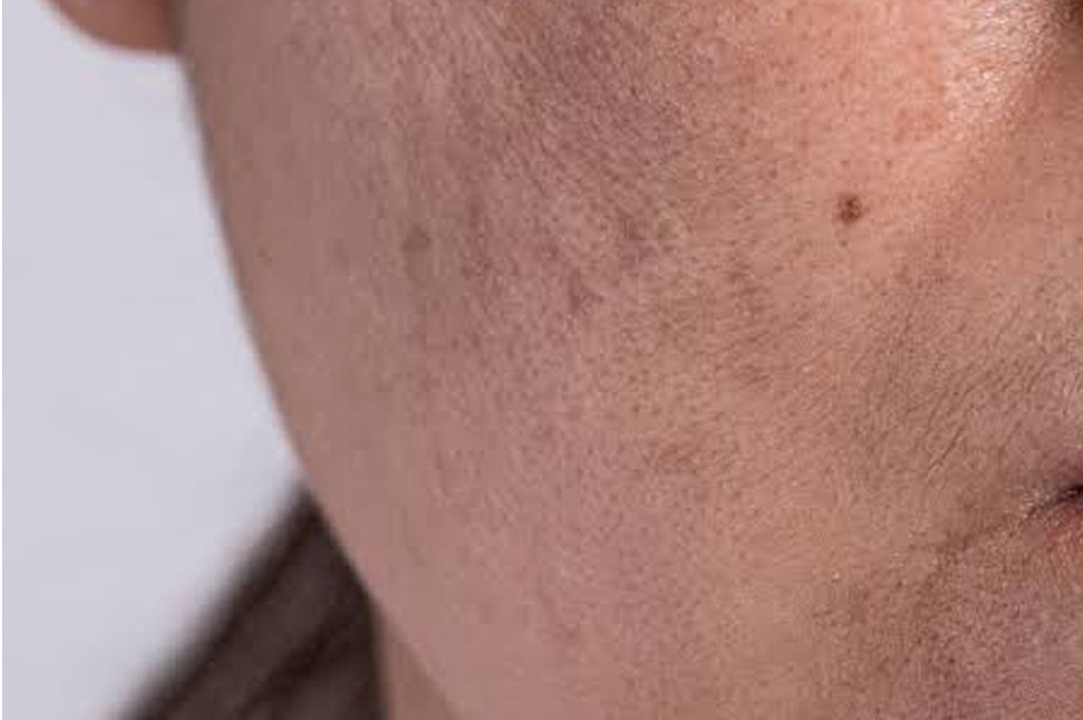 Eziologia del Melasma e Trattamento K-Beauty | Pharma Italia Group