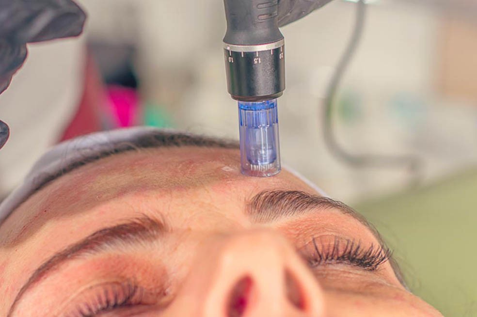 Microneedling & Nanoneedling 2026: La Scienza della Rigenerazione Cutanea